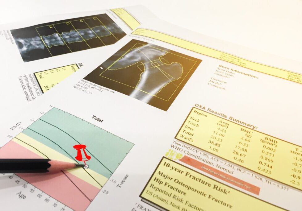 DXA Scanning