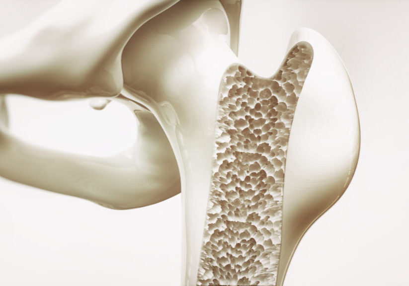 Osteoporosis stage 4 of 4 - upper limb bone - 3d rendering