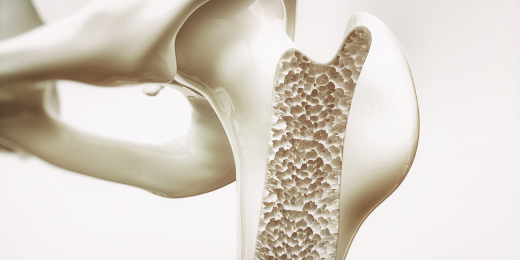 Osteoporosis stage 4 of 4 - upper limb bone - 3d rendering