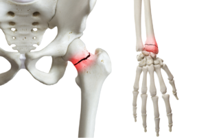 Fractured hip and wrist Fractured hip and wrist