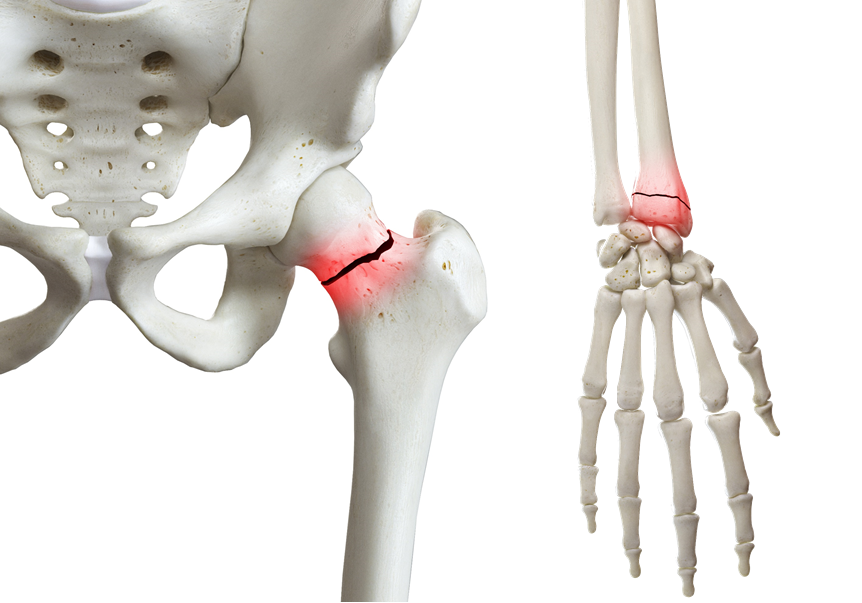 Fractured hip and wrist