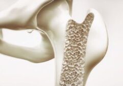 Osteoporosis Osteoporosis