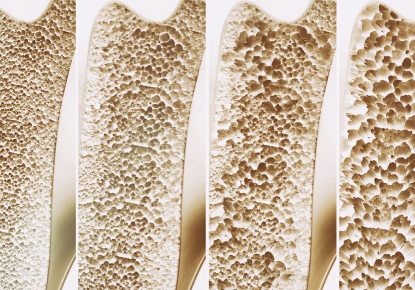 Osteoporosis