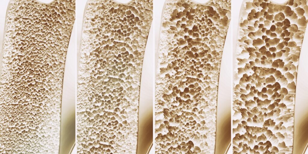 Osteoporosis