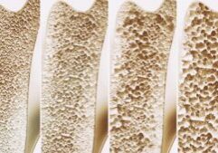 Osteoporosis Osteoporosis