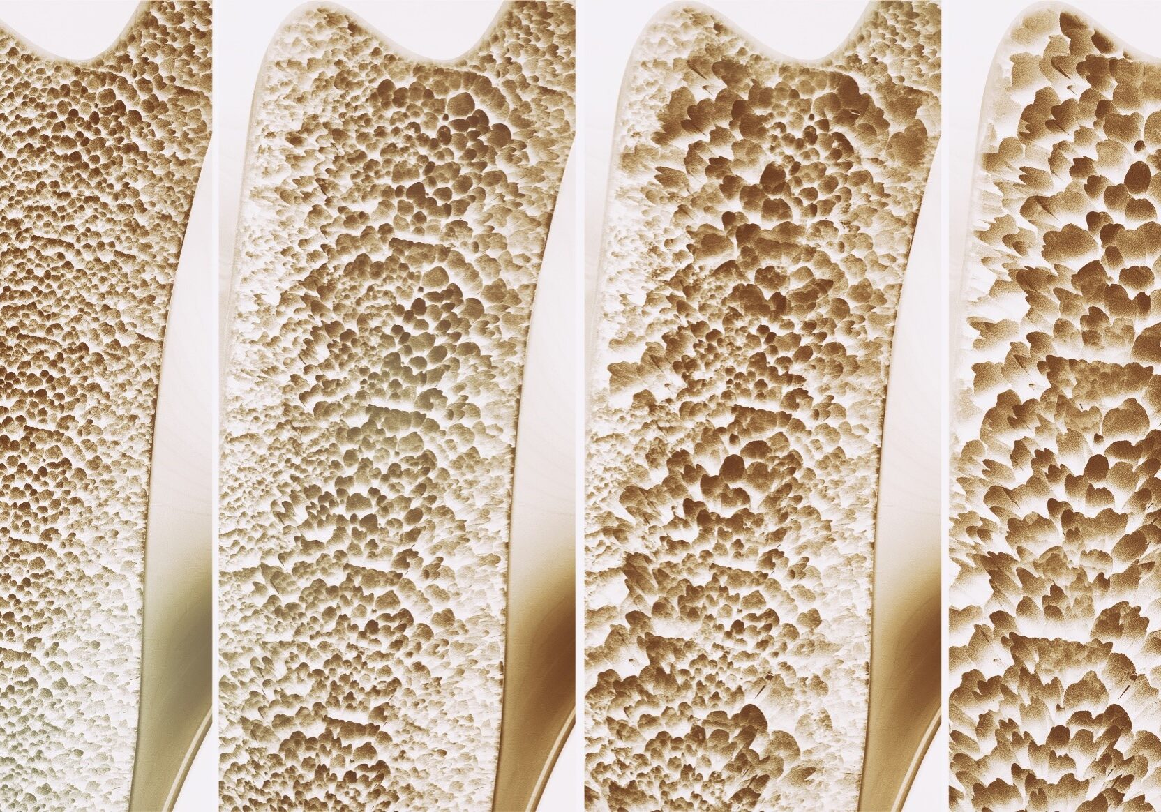Osteoporosis